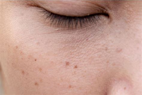 What Is Hyperpigmentation In Your Face Melanin In Skin