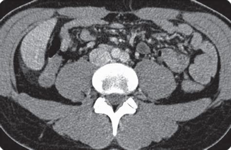 Axial Ct Of Pathologic Para Aortic Lymph Nodes Download Scientific