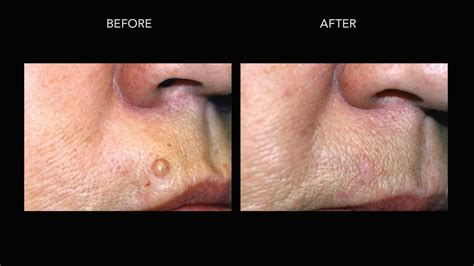 Mole Removal Before And After Photos Dermmedica