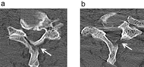 Cervical Ct Showed A Spinous Process Fracture Arrow At The C6 A And