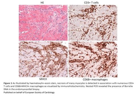 European Society Of Cardiology Journals On Twitter Fulminant Lyme