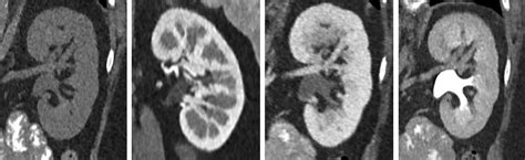 Ct and mri are used both for detection and characterization of neoplasms suspected to represent renal four of the 12 patients developed acute renal failure related to hepatorenal syndrome; Renal Imaging: Core Curriculum 2019 - American Journal of ...