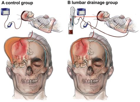 Study Design A Control Group Without Lumbar Csf Drainage And Increased