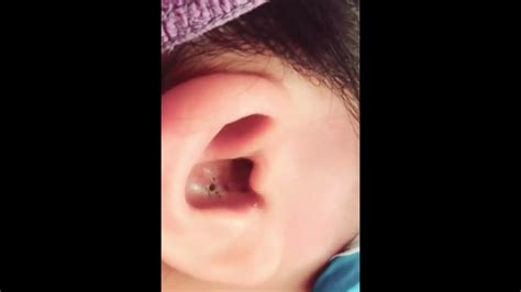 Multiple Ear Blackheads Removed With Satisfying Extraction Blackheads