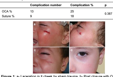 Figure 1 From Prospective Comparison Of Primary Wound Closure With