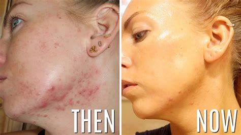 Dan kern, acne.org founder & cso last updated. HOW I CONTROL MY ACNE | Skincare Favorites for Cystic Acne ...