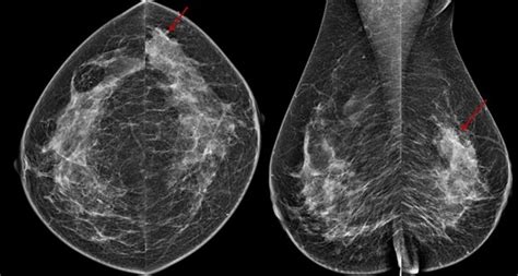3d Mammography Tomosynthesis Diagnostic Mammogram Densebreast Info