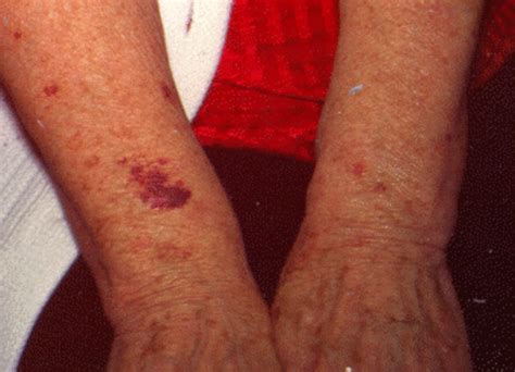 Causes Of Senile Purpura Information And Symptoms Of Senile Bleeding Or Bruises Hubpages
