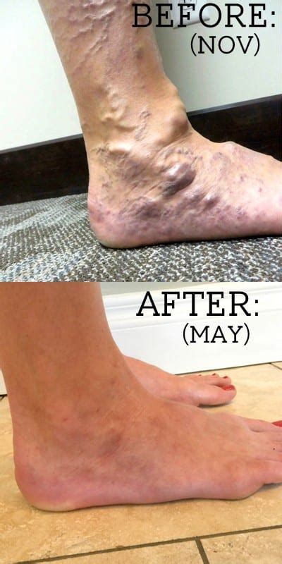My Varicose Veins Story Your Questions Answered Fun Cheap Or Free