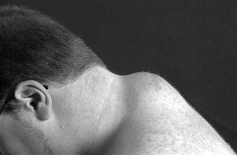 Soft Tissue Neck Lumps In Rugby Union Players British Journal Of