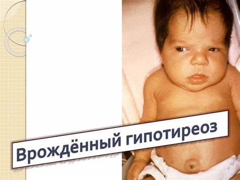 Врожденный гиподиреоз - презентация онлайн Картинка - Врожденный гиподиреоз - презентация онлайн