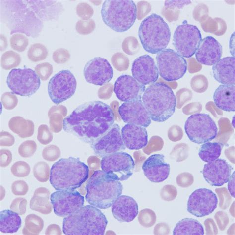 Peripheral Blood Smear Demonstrating A Spectrum Of