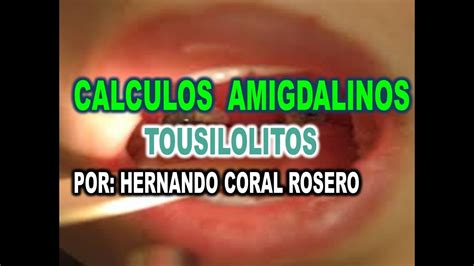 Calculos Amigdalinos Tonsilolitos Youtube