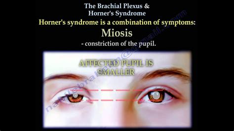 The Brachial Plexus Horner S Syndrome Everything You Need To Know