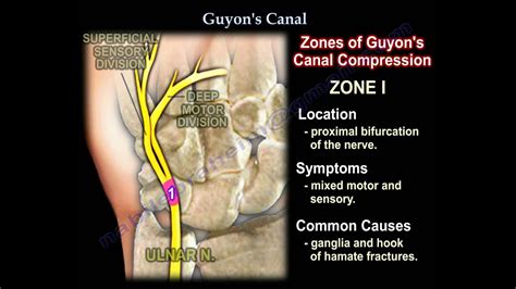 Guyons Canal Ulnar Tunnel Syndrome Everything You Need To Know Dr