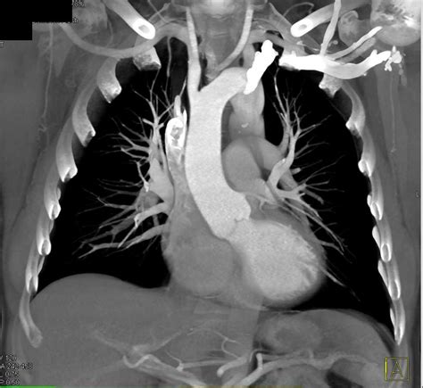 Prior Repair Of Coarctation Of The Aorta Cardiac Case Studies