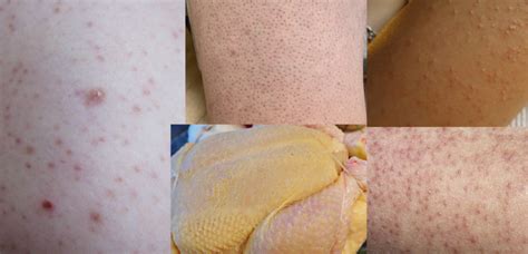 Keratosis Pilaris Chicken Skin Pictures Causes Treatment Home