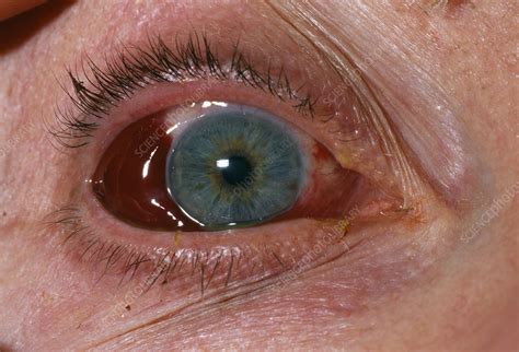 Eye Injury Stock Image M3301128 Science Photo Library