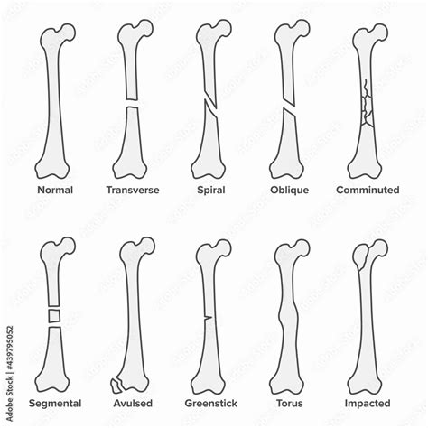 Types Of Fractures Broken Bones Stock Illustration Adobe Stock