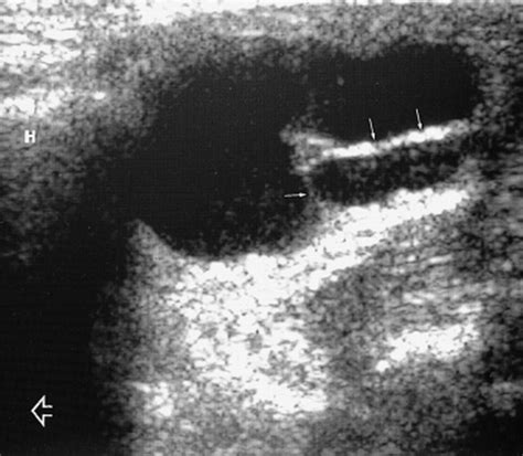 Thyroglossal Duct Cysts Sonographic Appearances In Adults American