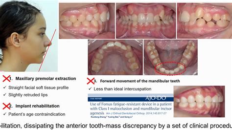 Dissipating Tooth Mass Discrepancy Caused By A Set Of Mandibular
