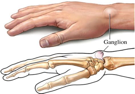 Ganglion Cyst Causes Management Of Painful Ganglion Cysts