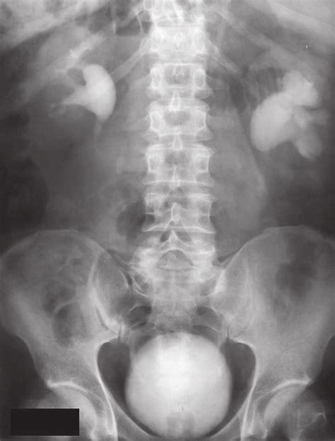 Bilateral Obstructive Hydronephrosis Identified By Intravenous