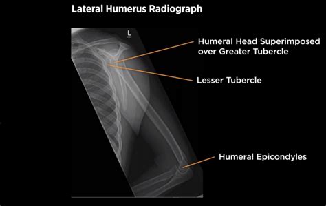 Optimal Lateral Humerus X Rays Positioning The Radiographers Guide