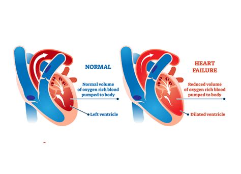 Right Sided Heart Failure Causes Symptoms And Treatment