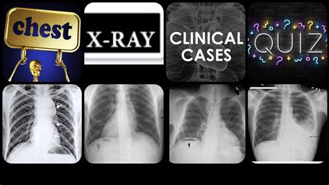 Chest X Ray Clinical Cases Quiz 1 50cases Chest Xrays ️chest Xrays