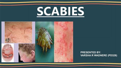 Scabies Case Presentation Soap Format Youtube