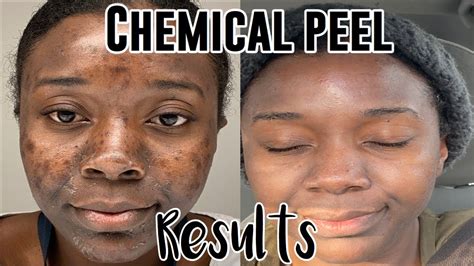 Chemical Peel On Dark Skin Peeling Process Results Before And After