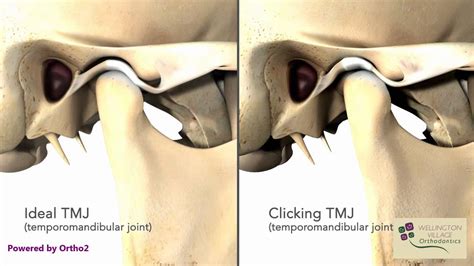 TMJ Clicking - Wellington Village Orthodontics - YouTube