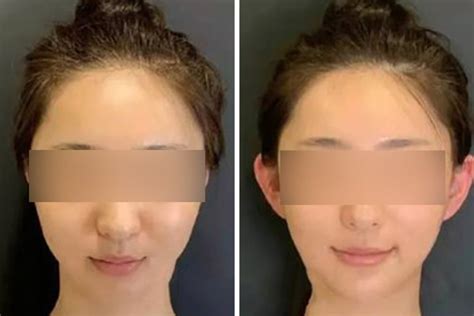 Chinas ‘elf Ear Cosmetic Surgery Increasingly Sought By Young People