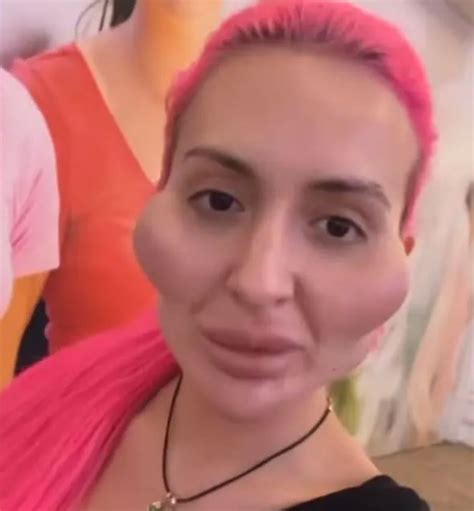 Model With ‘worlds Biggest Cheeks Gets Face Filler To Make Look Even More Extreme