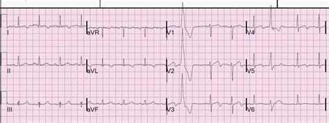 Dr Smith S ECG Blog Dynamic T Wave Inversion Apparent Wellens Waves