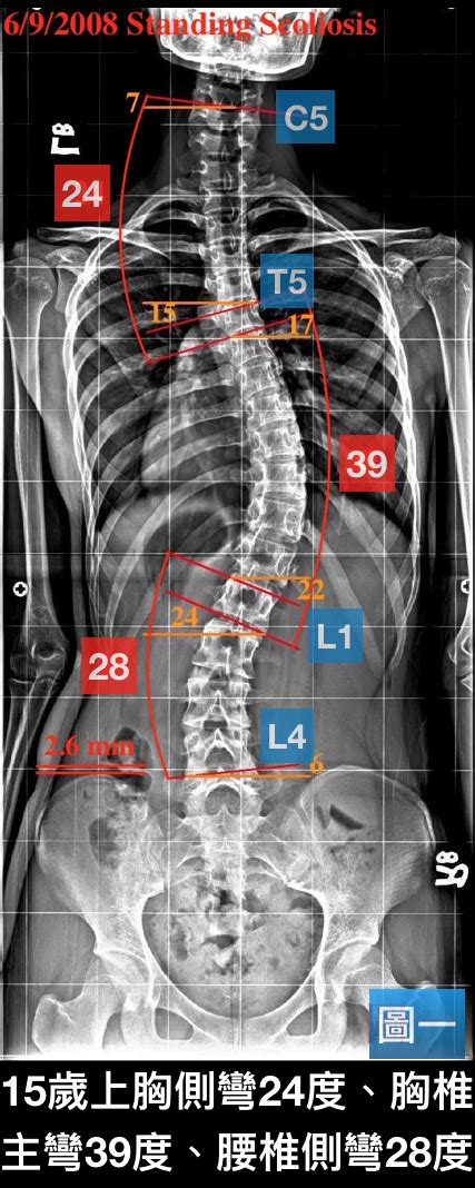 脊椎側彎矯正案例12 治療8次胸椎側彎 37度→30度 閻曉華脊骨神經醫學網