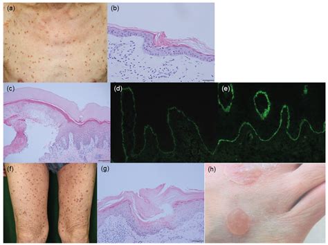 Two Cases Of Porokeratosis With Mvd Mutations In Association With