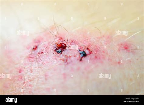 Skin Abrasion High Resolution Stock Photography And Images Alamy