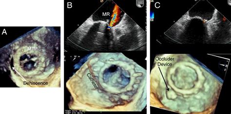 Real Time 3 Dimensional Transesophageal Echocardiography In The