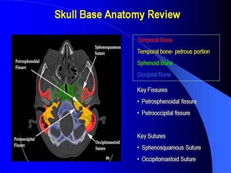 Ct Skull Base Anatomy Anatomical Charts And Posters