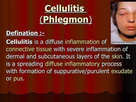 Cellulitis Face Treatment Doctor Heck