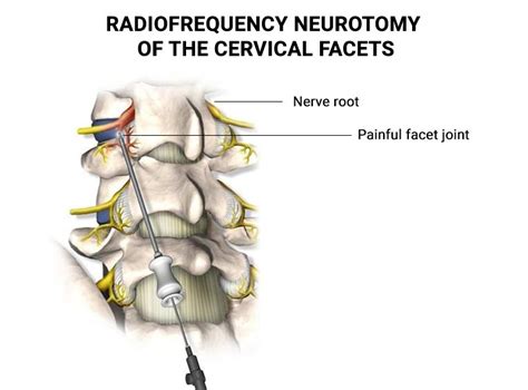 Radiofrequency Neurotomy Of The Cervical Facets The Spine And Rehab Group