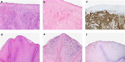 Squamous Cell Carcinoma Of The Urinary Bladder A With Negative Human