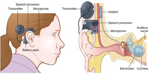 Cochlear Implant Know Its Function Procedure And Cost Of Installation