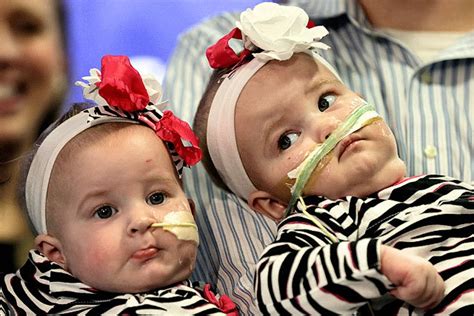 Once Conjoined Twins From Northern New York Make Their Debut At Pa