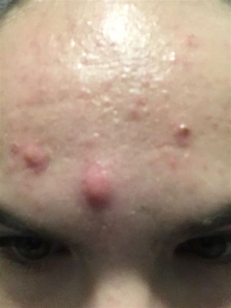 Acne Angry Red Pimples On Forehead And Cheeks Rskincareaddiction