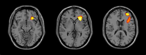 The Adolescent Brain Develops Differently In Bipolar Disorder