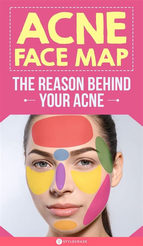 Acne Face Map What Is Your Acne Trying To Tell You In 2020 Face