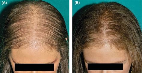 Alopecia Androg Nica Qu Es Causas S Ntomas Tratamiento Y Mucho M S